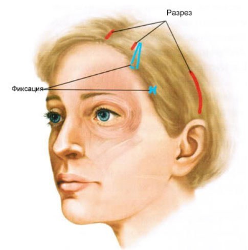 Эндоскопическая подтяжка лица: прогрессивная методика и ее суть