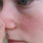 Лечение купероза на лице дома, в салоне красоты или медучреждении